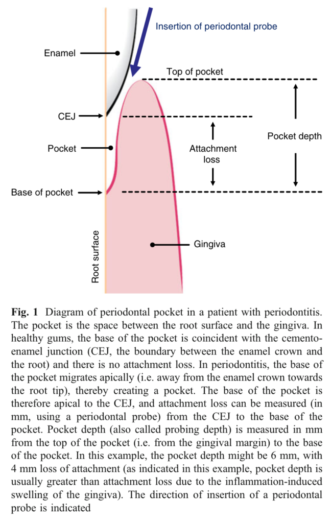 Periodontal pockets